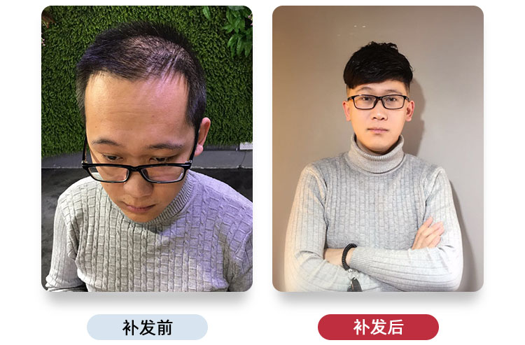 头顶发际线稀疏怎么办？（头顶发际线稀疏的解决办法）