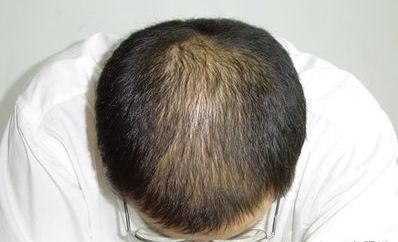 脱发去医院挂什么科？