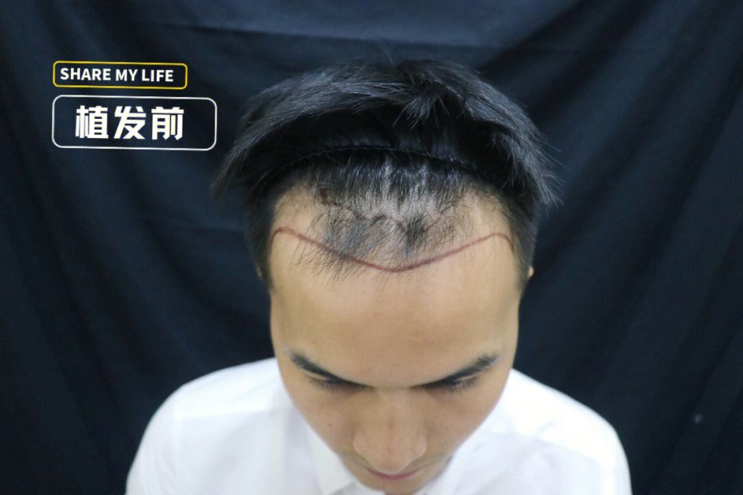 不剃发植发成活率高么？