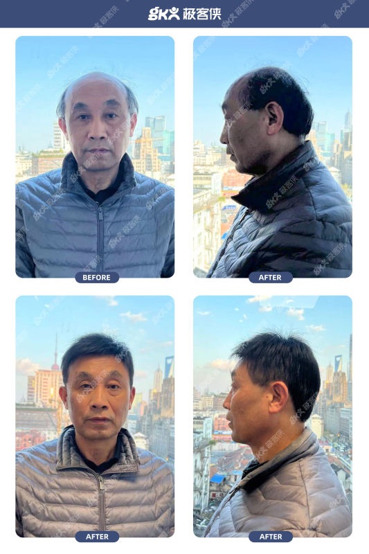遮盖头顶和两边白发的假发片哪里有？（地址分享）
