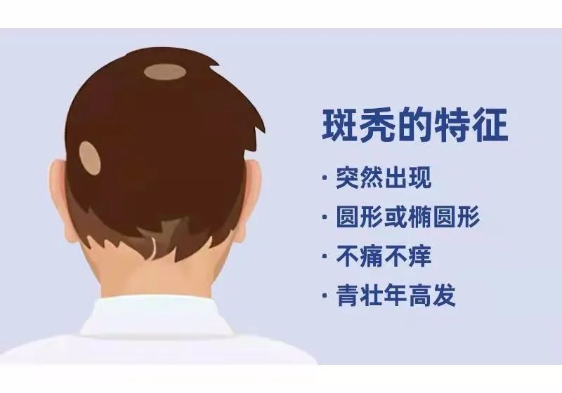 斑秃可以自愈吗？（看实际情况）