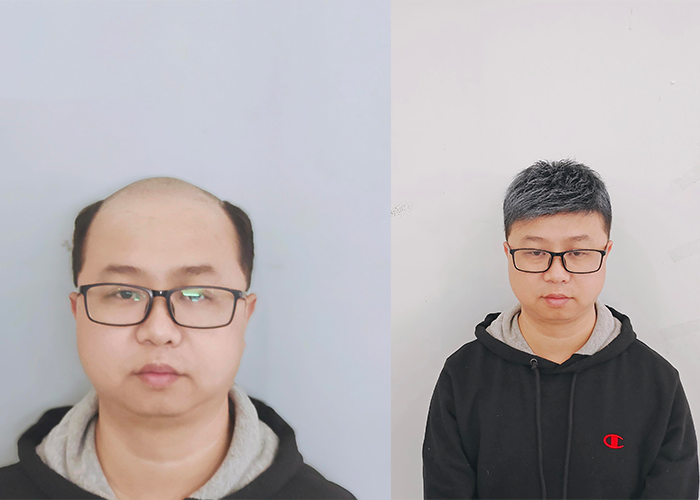 脱发的用户佩戴效果很赞,也自己做一个非常满意