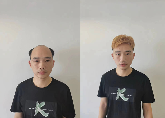 戴几天也没人看出来,隐形效果真的很好