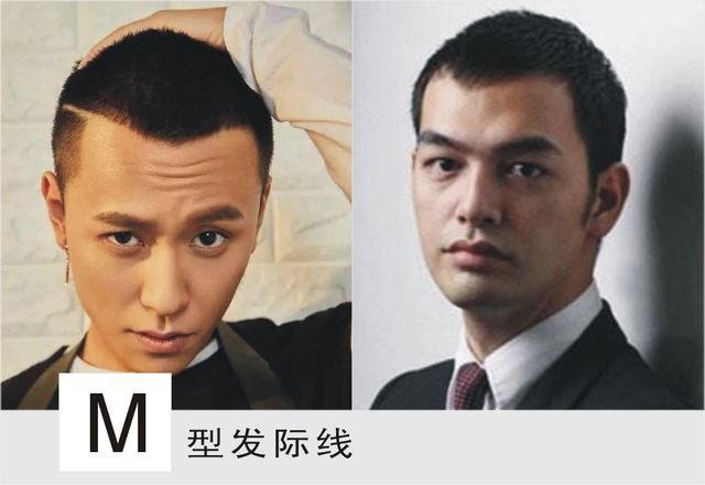 m型发际线