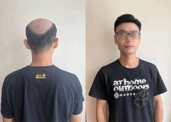 不仅发际线恢复自然,整体造型也很时尚