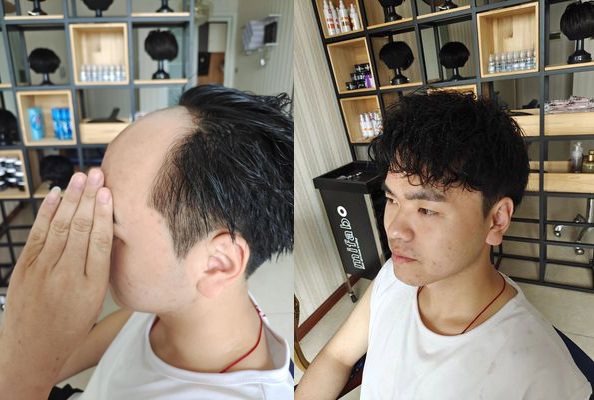如何治疗脱发？原来这是“头发再造”最有效的方法！（脱发掉发怎么办）