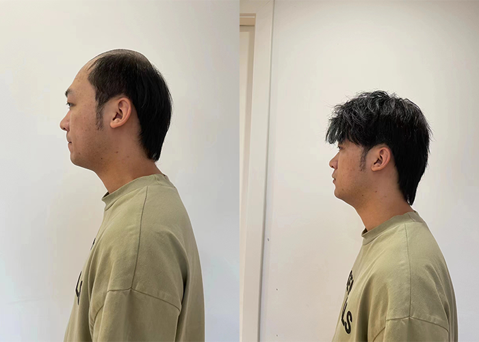 简直是把我的头顶烦恼一键‘脱发’