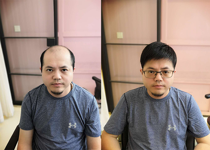 海南假发补发店哪家好？（用过的这样说）