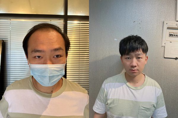 发际线补发效果