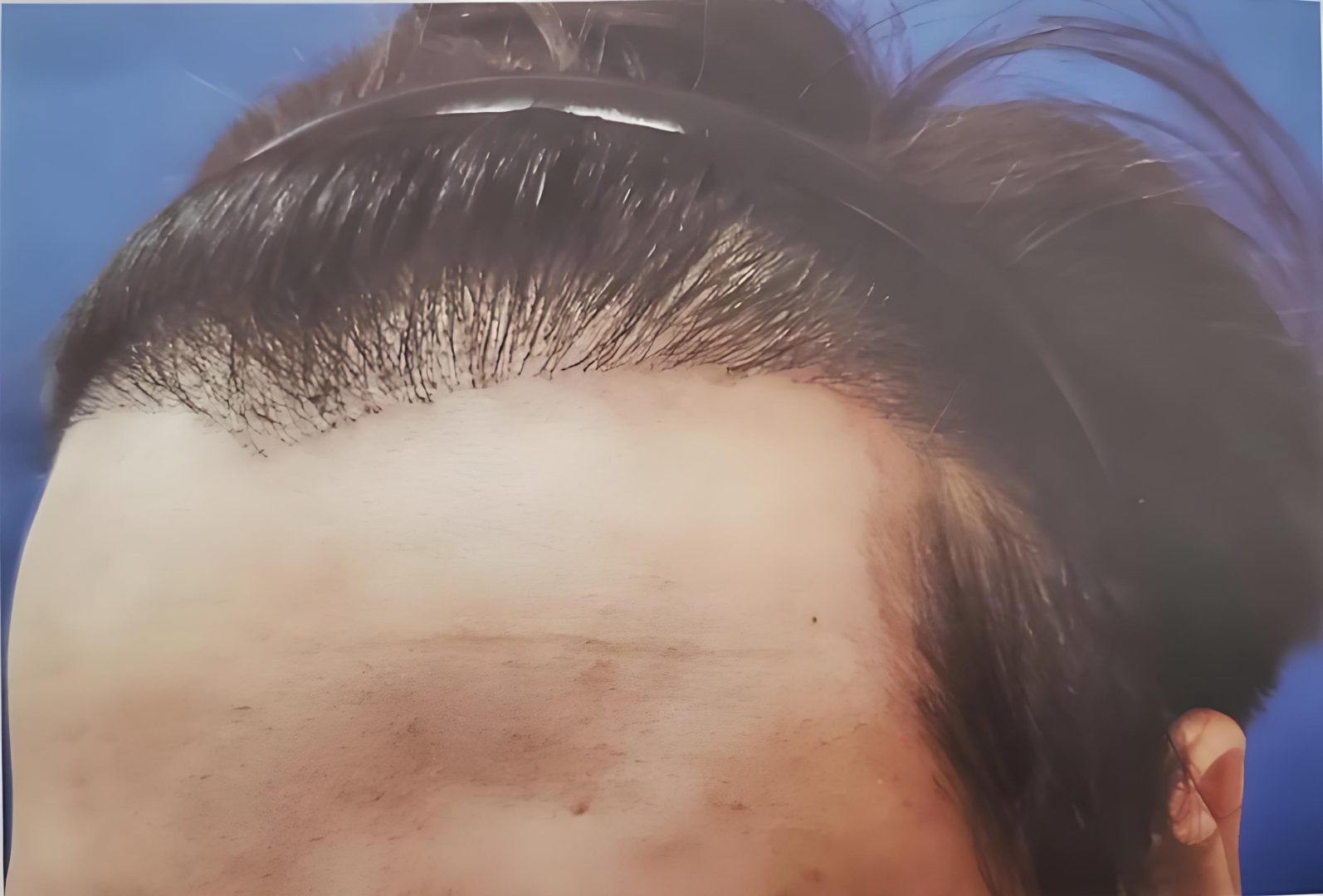 手术恢复不当