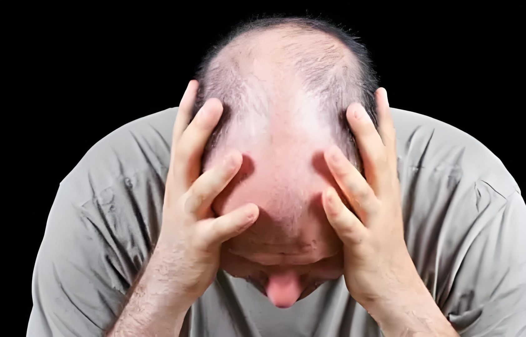 为什么很多人都怕脂溢性脱发?