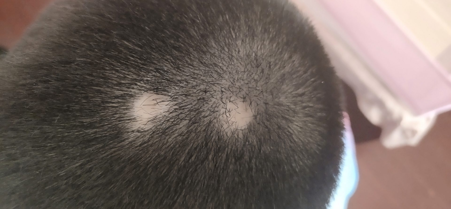 年轻人斑秃可以自愈吗？（这才是全面的答案）