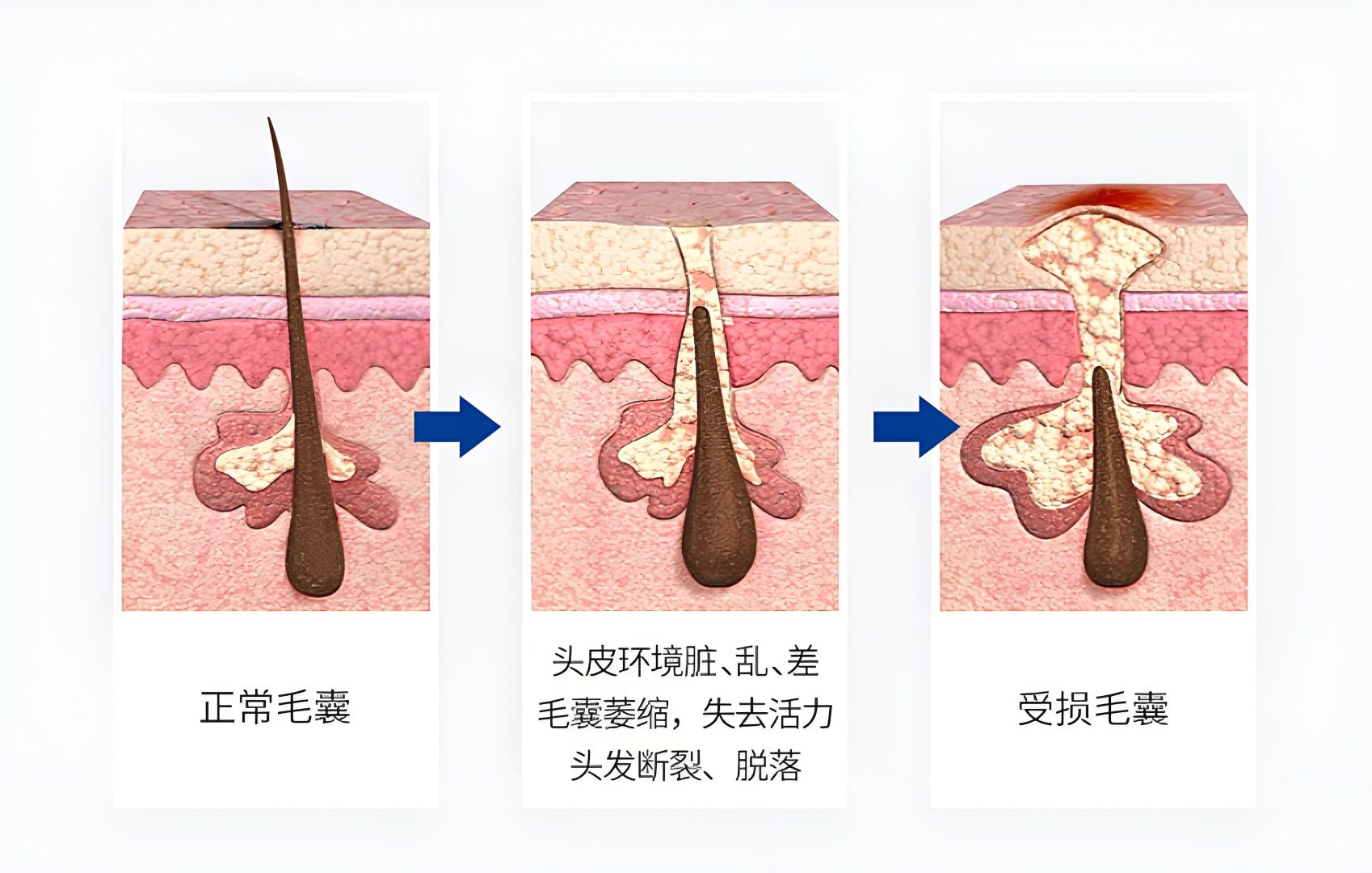 清洁头皮