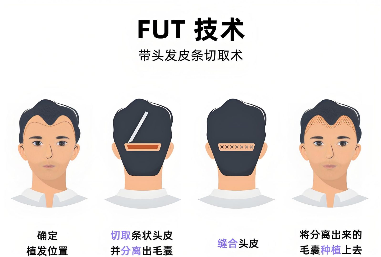 影响发际线植发维持时间的因素