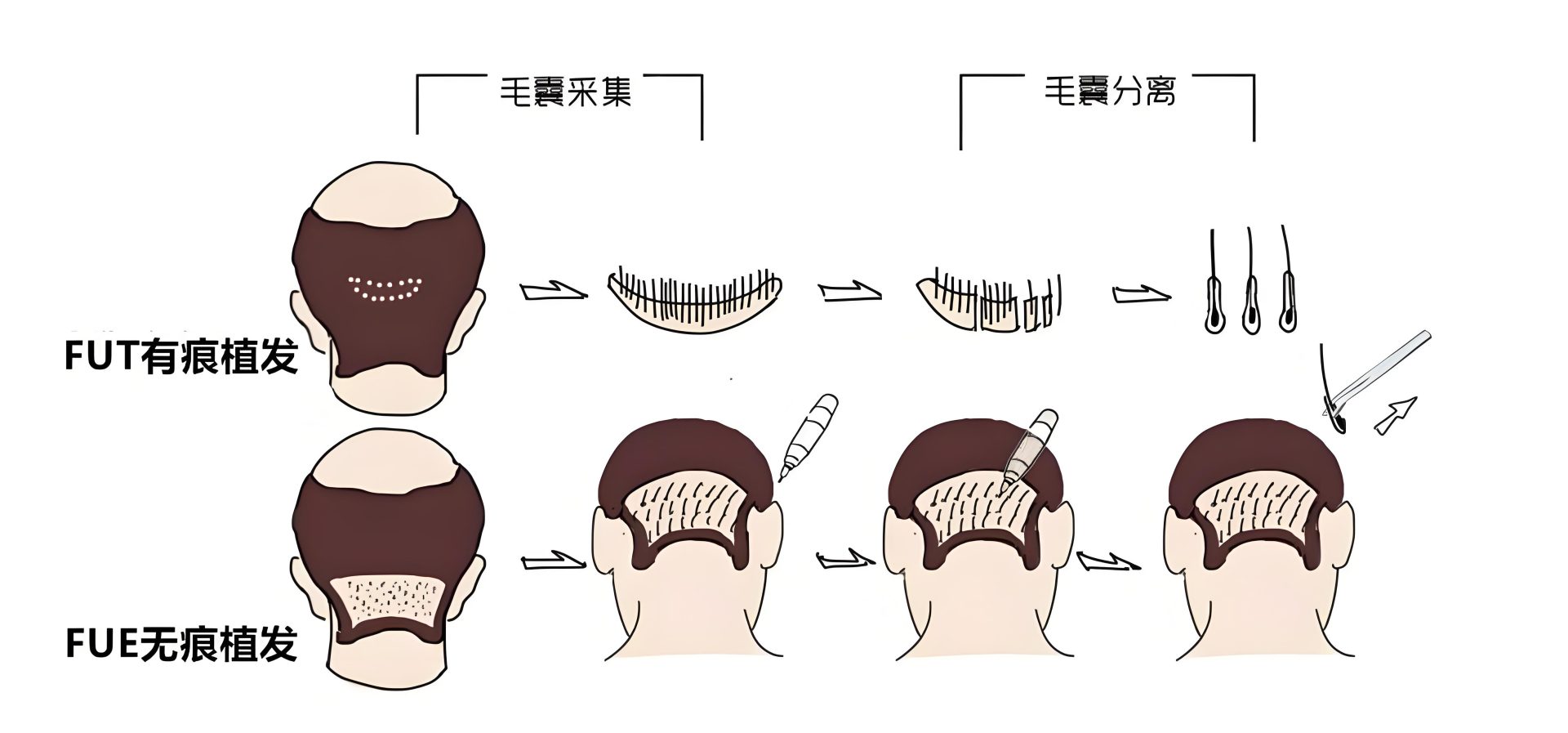发际线植发维持时间的范围