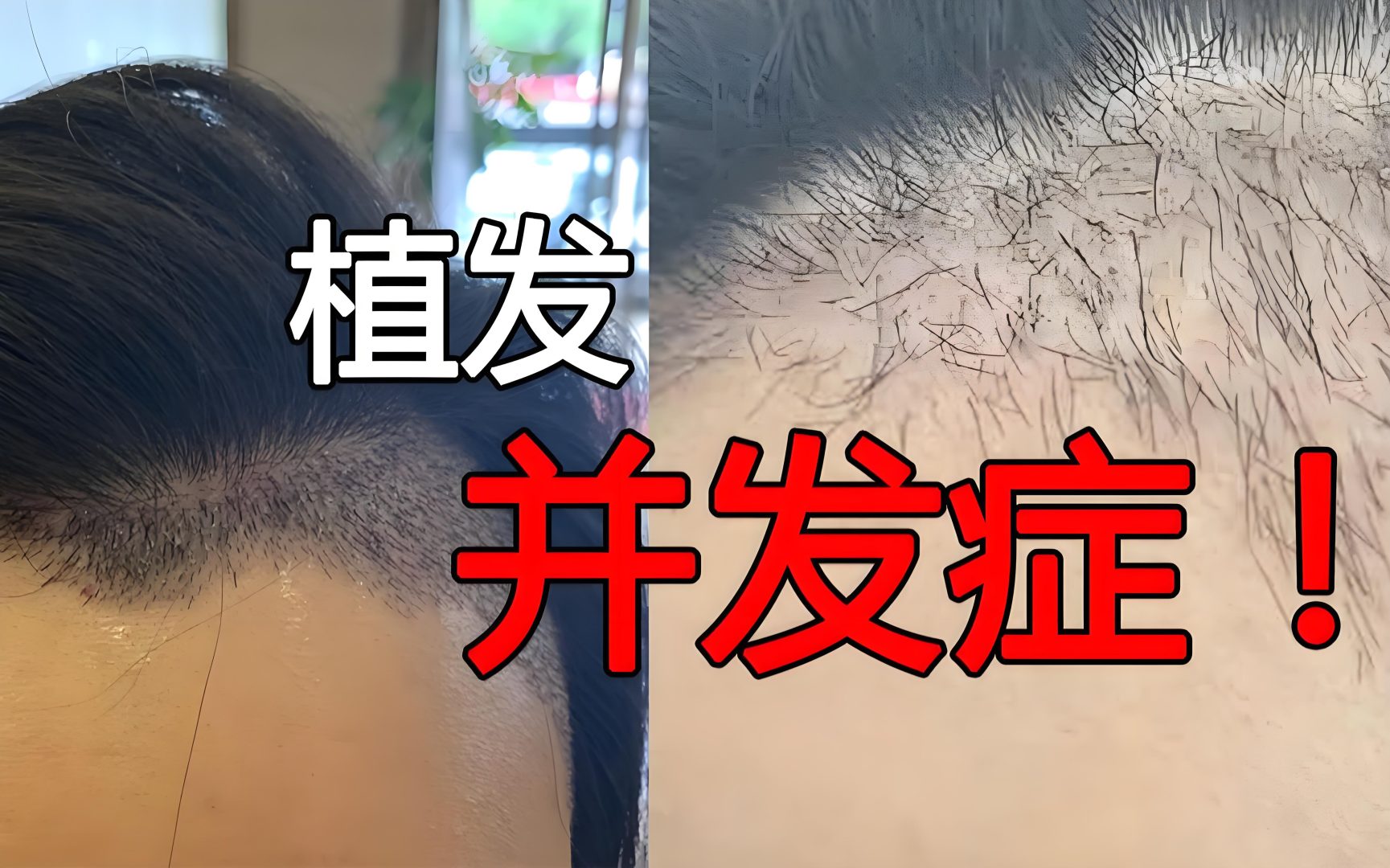 植发手术的风险与并发症