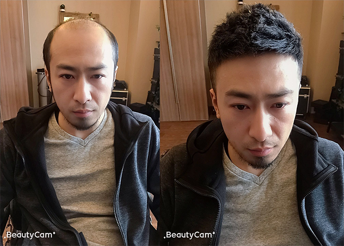 秃顶补发效果