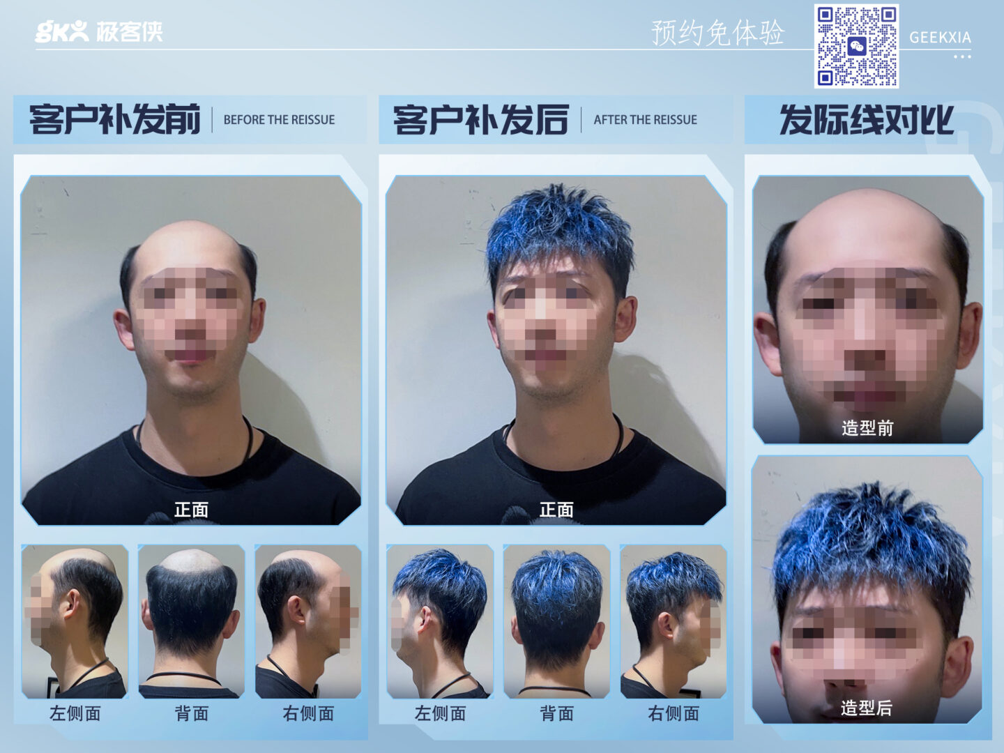 脂溢性脱发,用假发补救效果