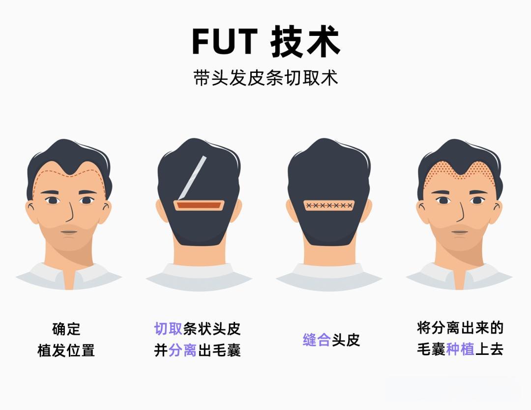 FUT植发技术