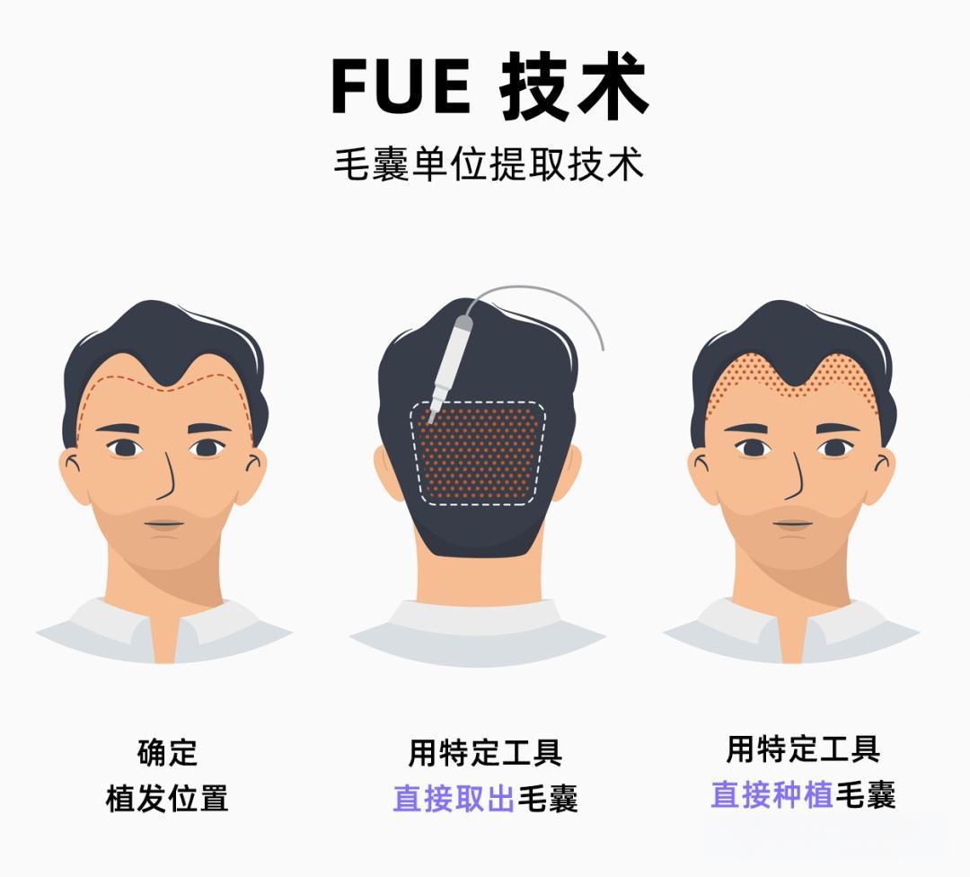 FUE植发技术
