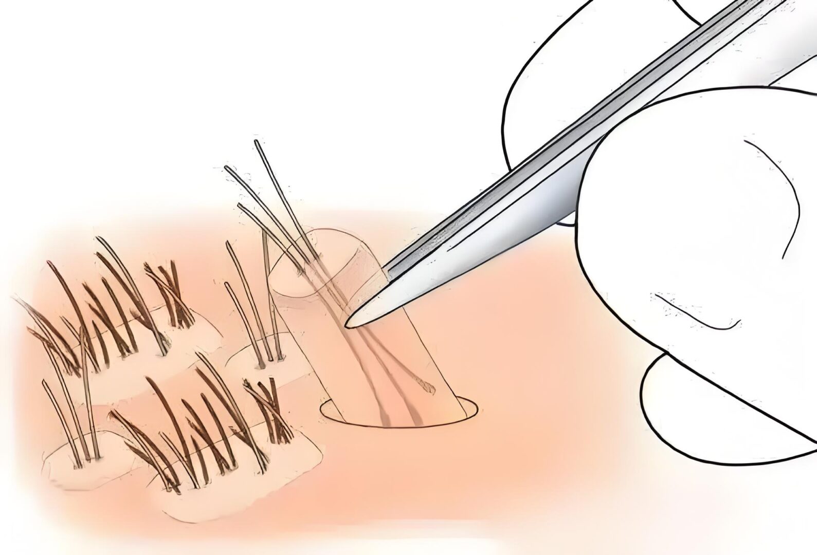 提取毛囊