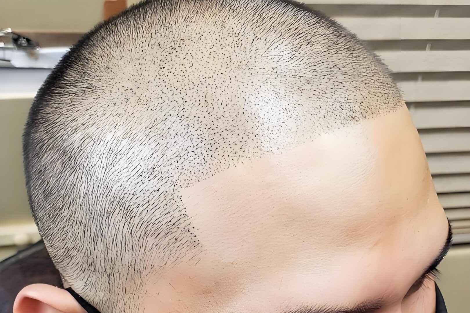 ?纹发对头皮有伤害吗？