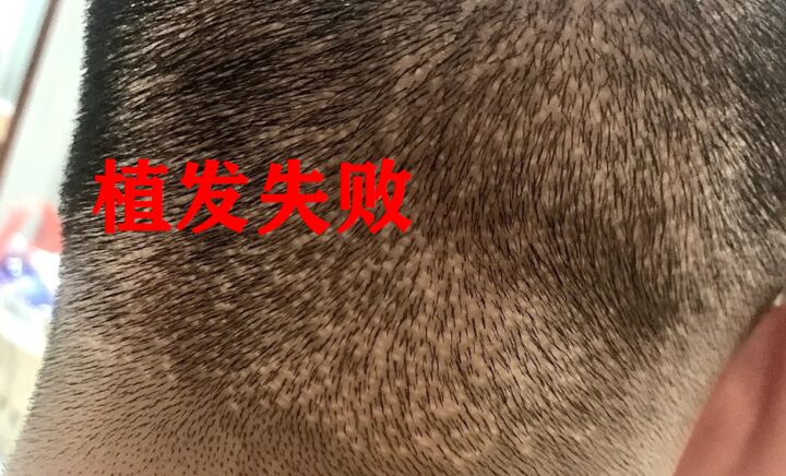植发失败