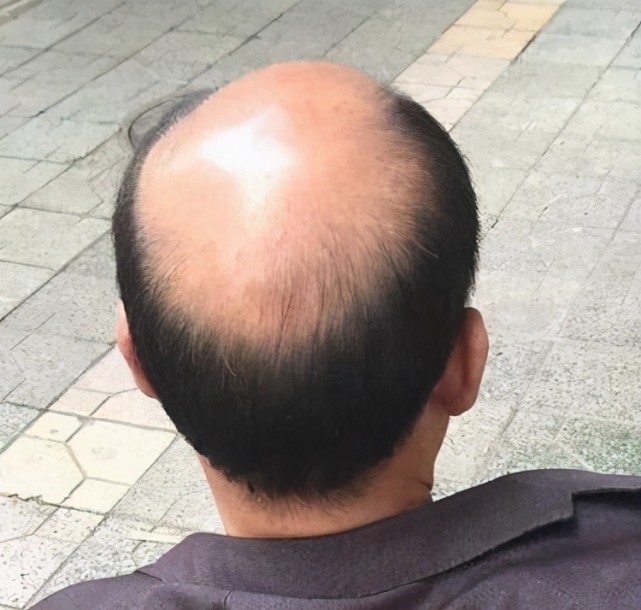 地中海式秃顶