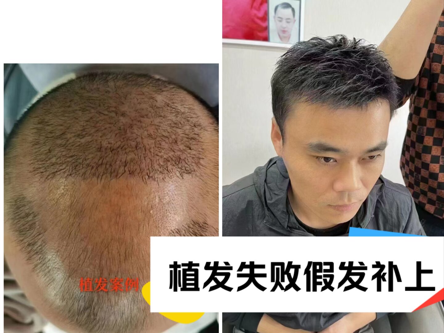 ?植发失败案例触目惊心！选择植发机构，这些坑千万别踩！