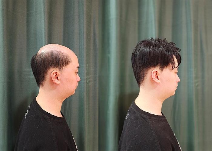秃顶佩戴极客侠假发前后效果对比